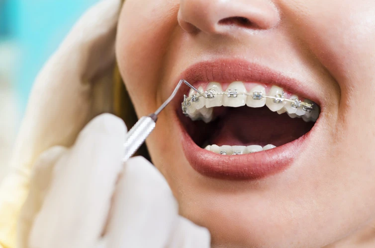 How Long Does It Take For Braces Glue To Dry?