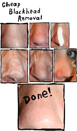 Other Methods To Remove Blackheads