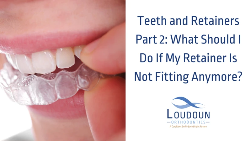 Step 4: Hold The Retainer Together