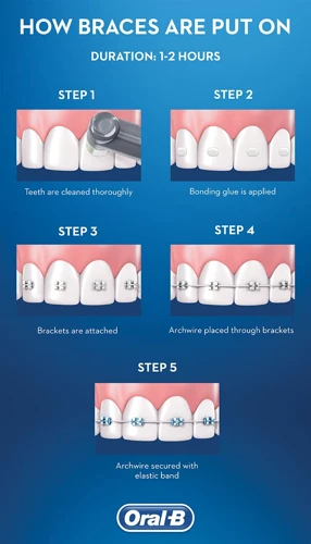 The Process Of Applying Braces Glue