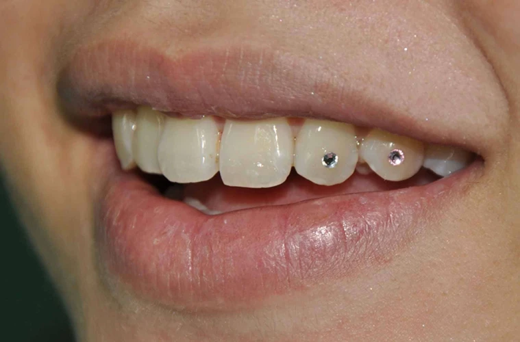 Tips And Precautions Before, During, And After Removing Tooth Gem Glue