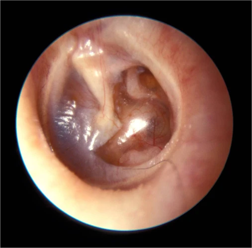 What Are The Symptoms Of Glue Ear?