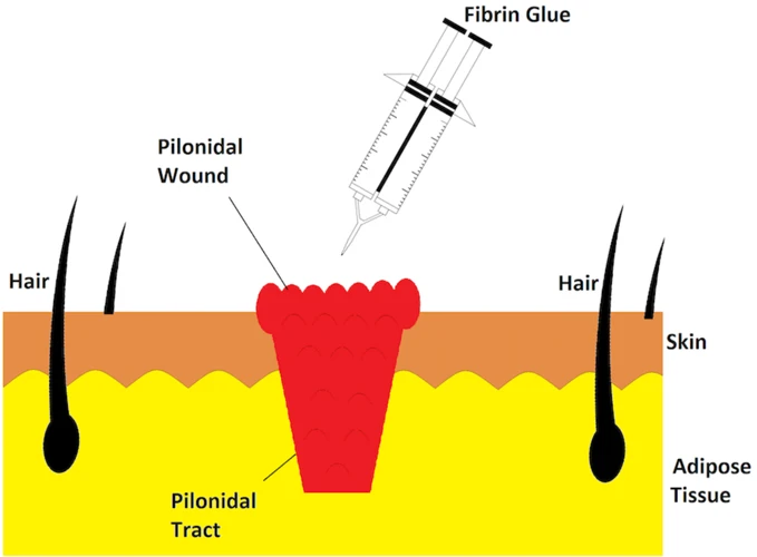 What Is Fibrin Glue?
