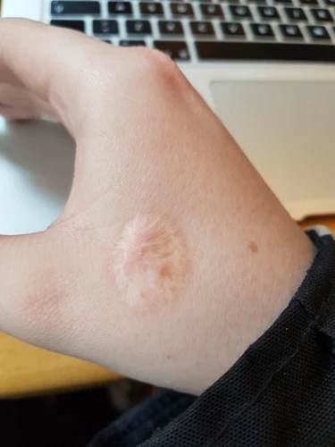 What To Do If Hot Glue Gets On Skin